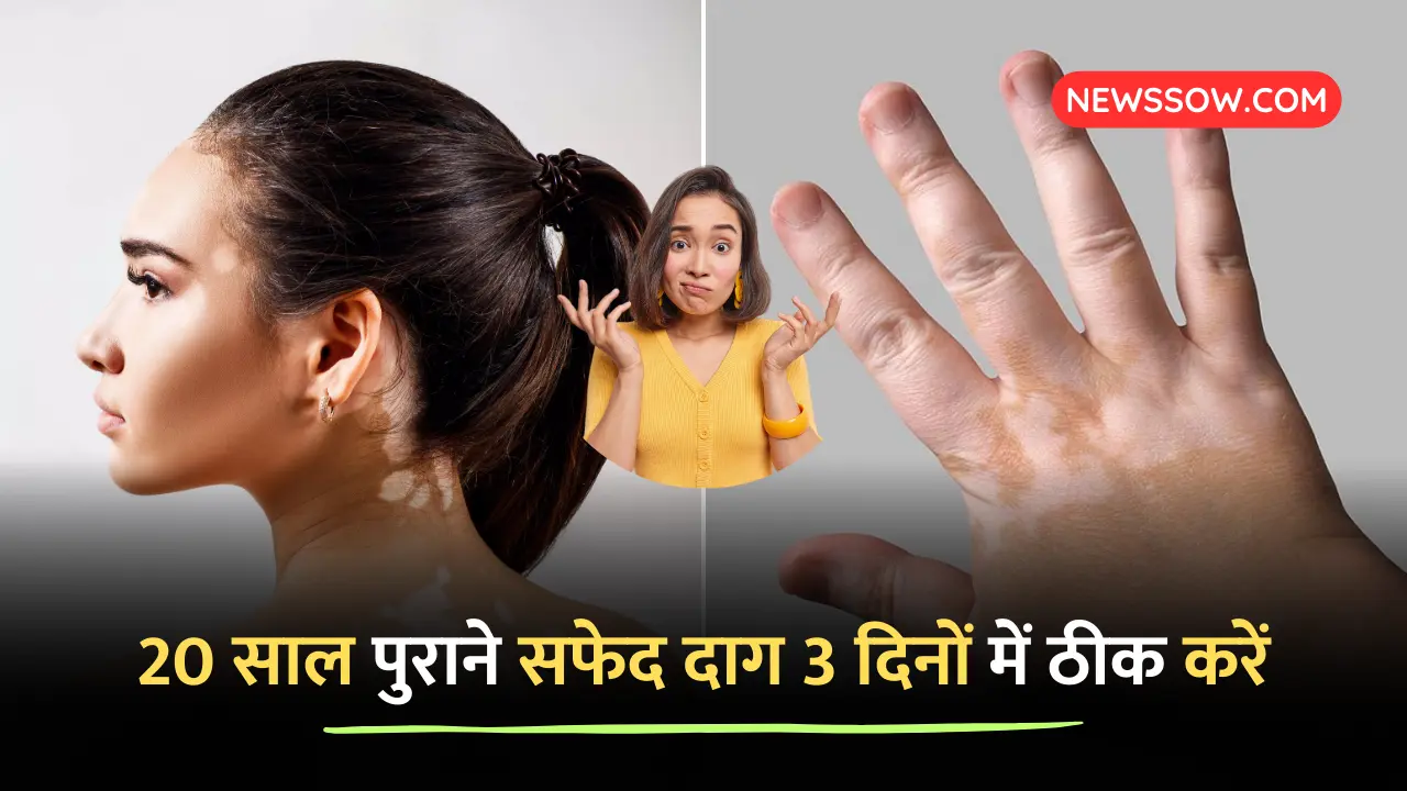 20 साल पुराने सफेद दाग 3 दिनों में ठीक हो गई : सही तरीका अपनाए 20 साल पुराने सफेद दाग 3 दिनों में ठीक हो गई : सही तरीका अपनाए